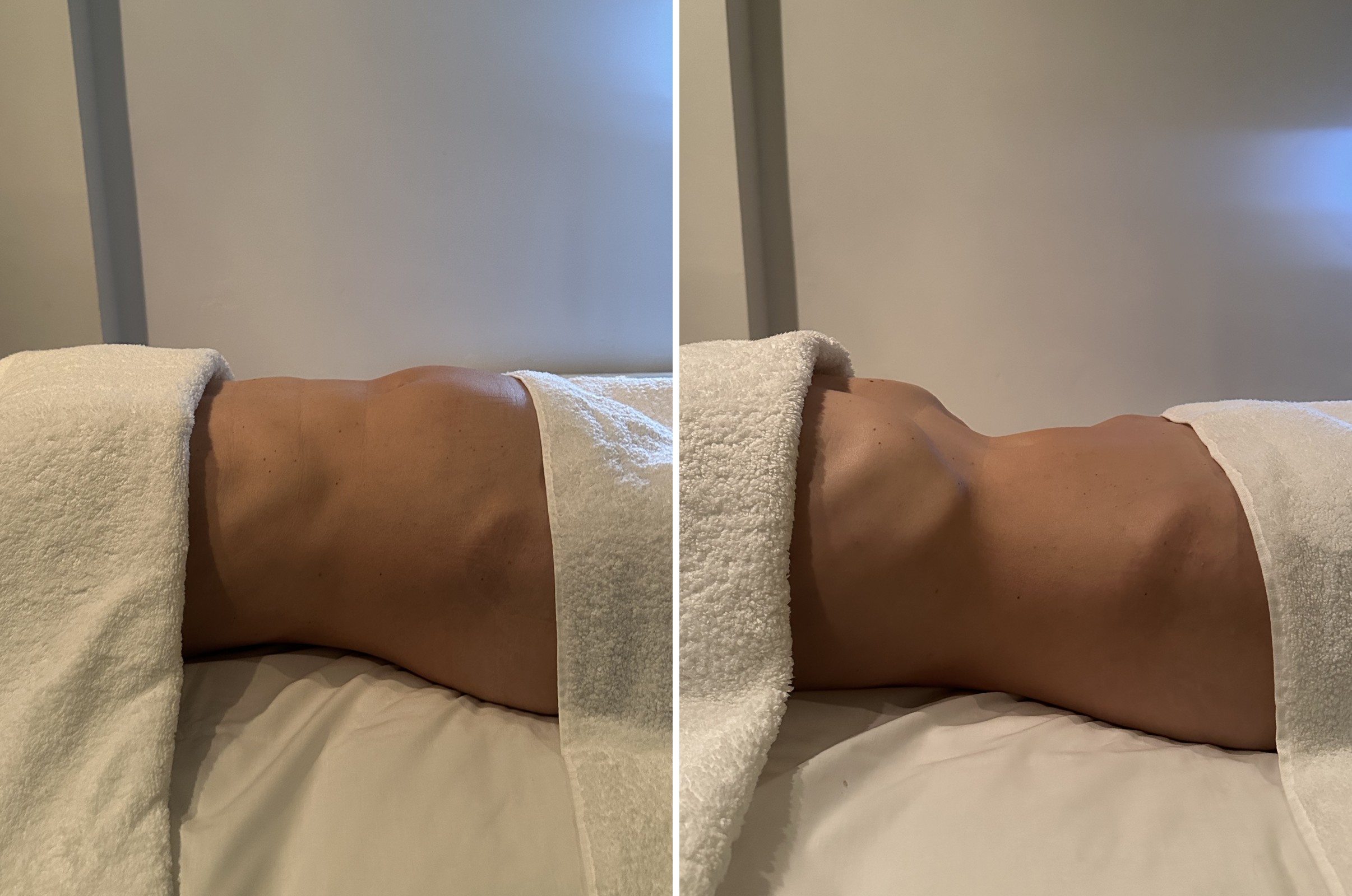 Sculpting Massage before and after - visible contour change