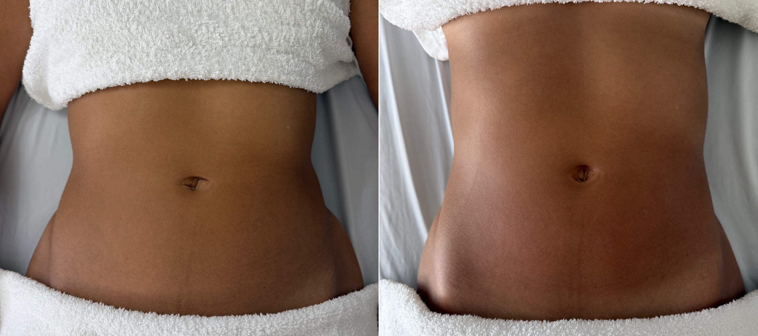 Lymphatic Drainage before and after - visible waist reduction